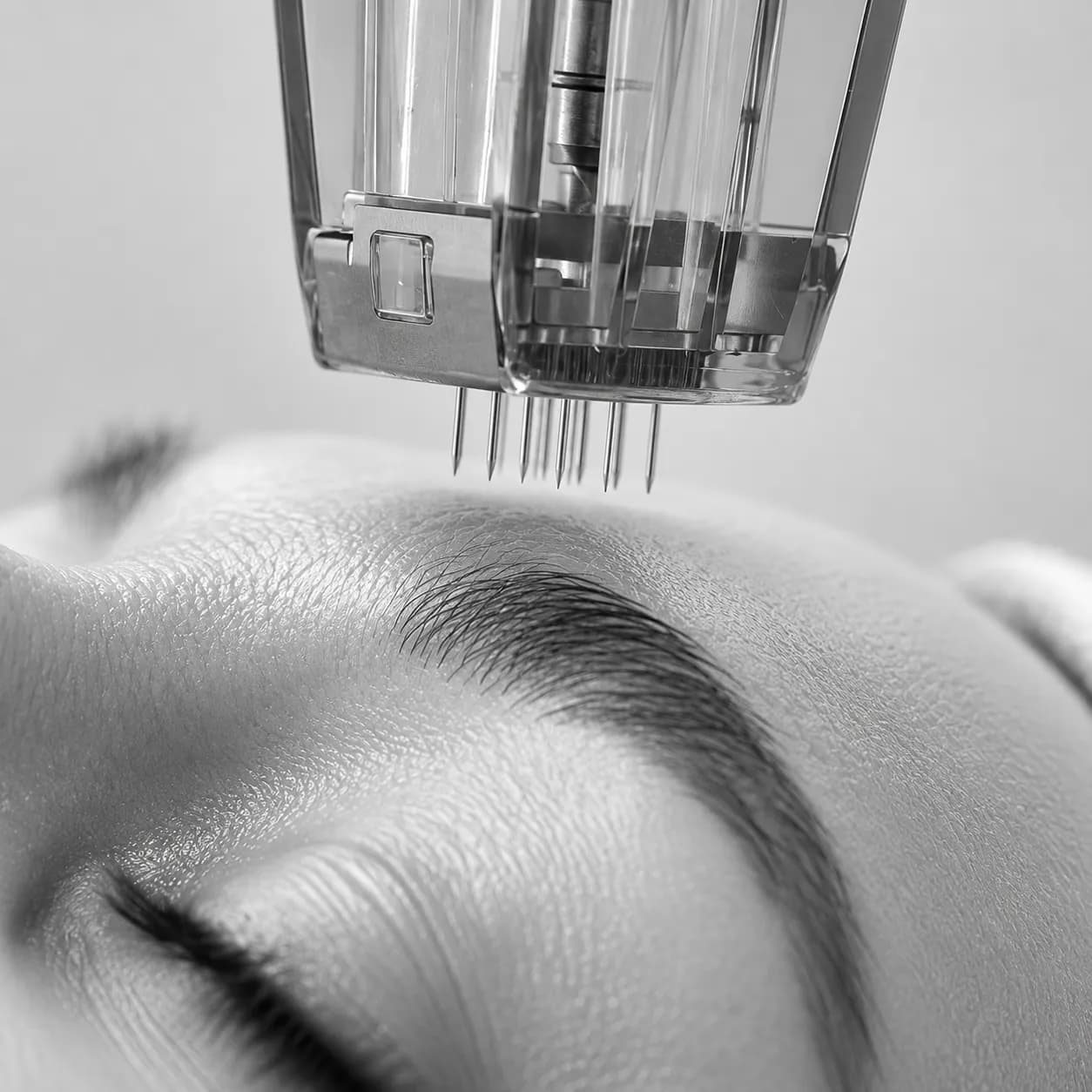 Skin Resurfacing